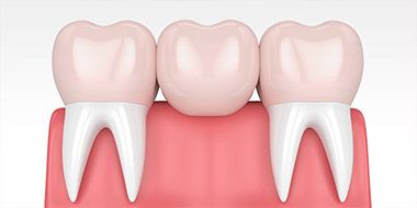 Bridges and crowns for teeth