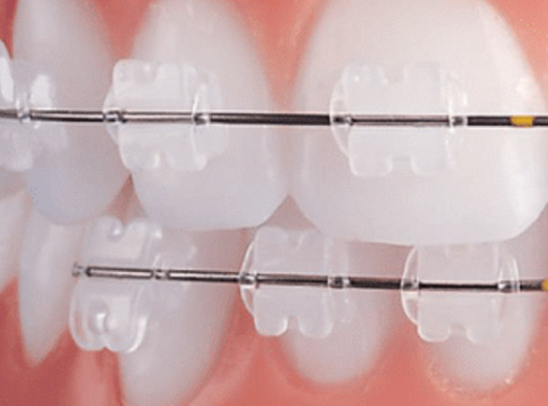 Ceramic orthodontic braces: