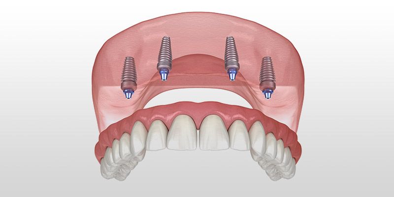 All-On-4 Removable Denture