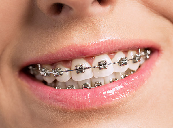 Self-ligating fixed braces: