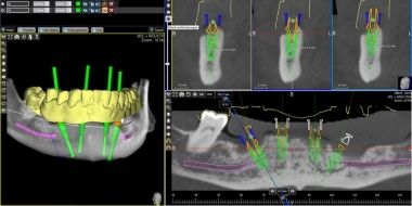 Implants in 1 hour