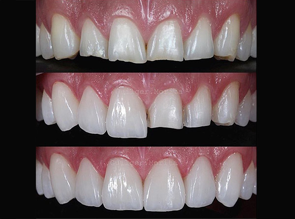 Dental veneers are thin prosthetic coverings that are attached to teeth.