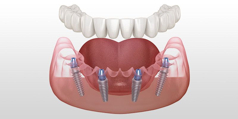All-On-4 zęby mocowane na stałe