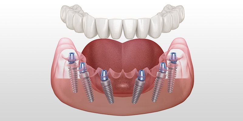 All-On-6 zęby mocowane na stałe