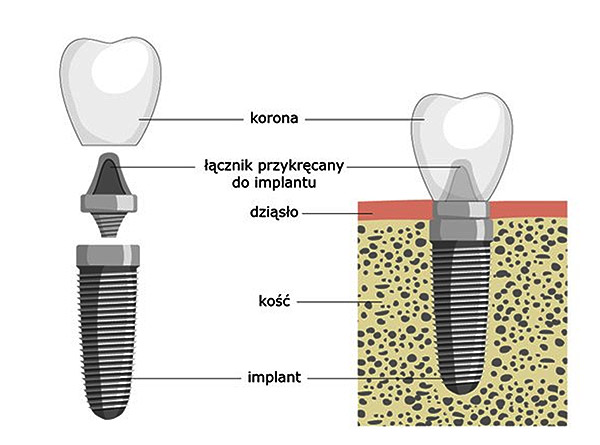 Implant składa się z trzech elementów