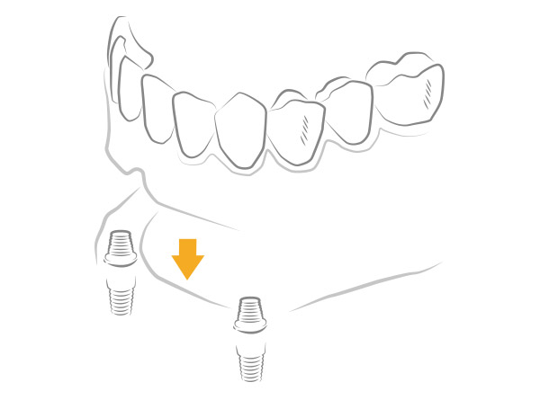 Overdenture