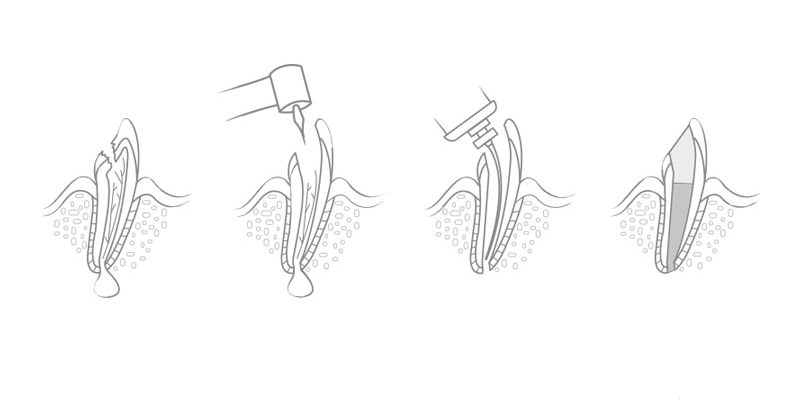 Etapy leczenie endodontycznego