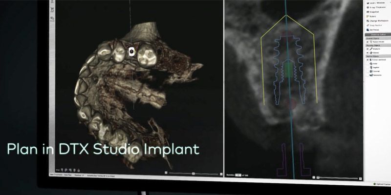 Plan w DTX Studio Implant