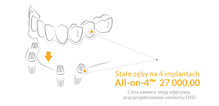 All-on-4™