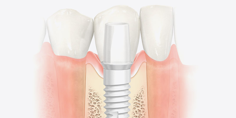 Cyrkonowy implant Nobel Pearl