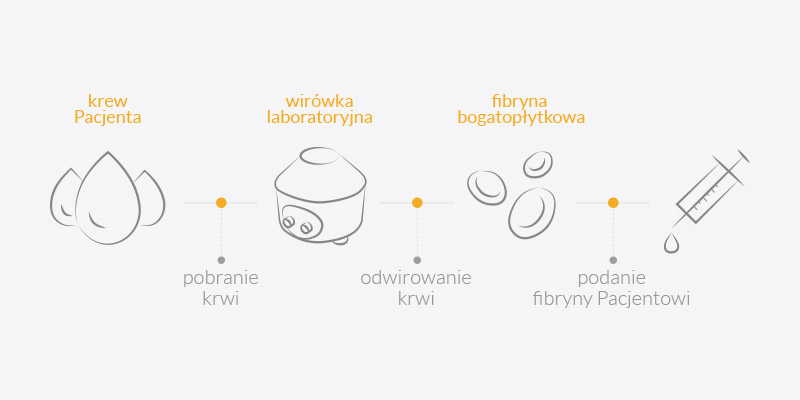 Fibryna bogatopłytkowa - procedura zabiegu w Luxdentica